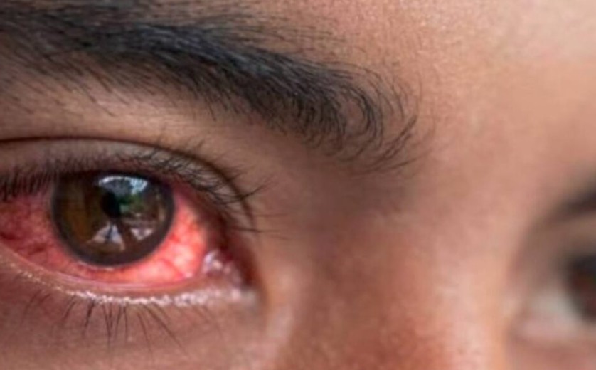 Pink eye