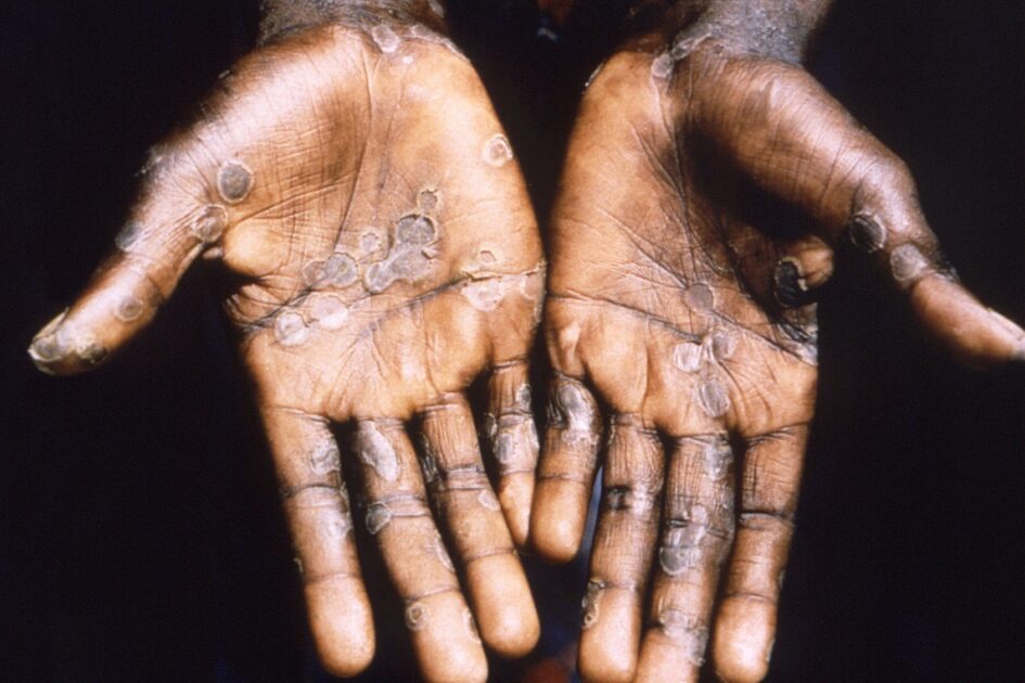 A mutated strain of Mpox, formerly known as monkeypox and akin to smallpox, is rapidly spreading in the Democratic Republic of Congo (DRC).